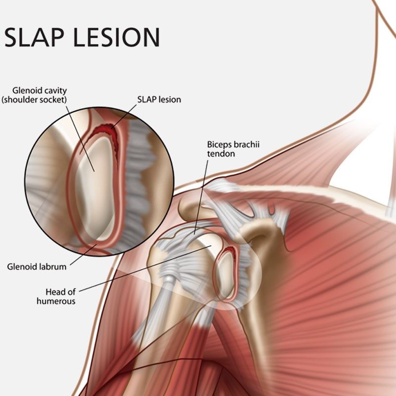 Slap Lesion