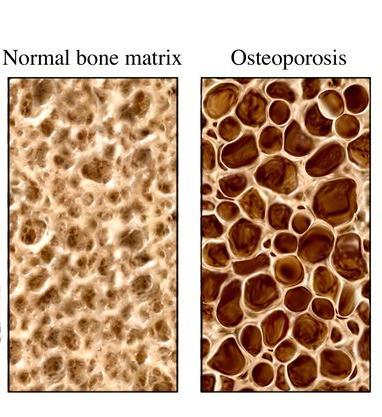 xosteoporosis3.jpg.pagespeed.ic.npdw10dexg.jpg