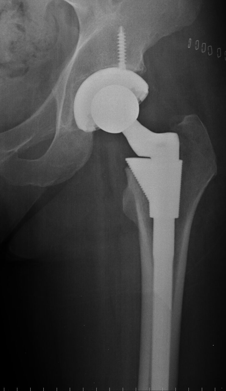 hip-replacement.jpg