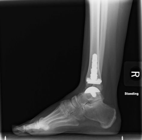 image_nemec_total_ankle_x-ray1_optimized.jpg