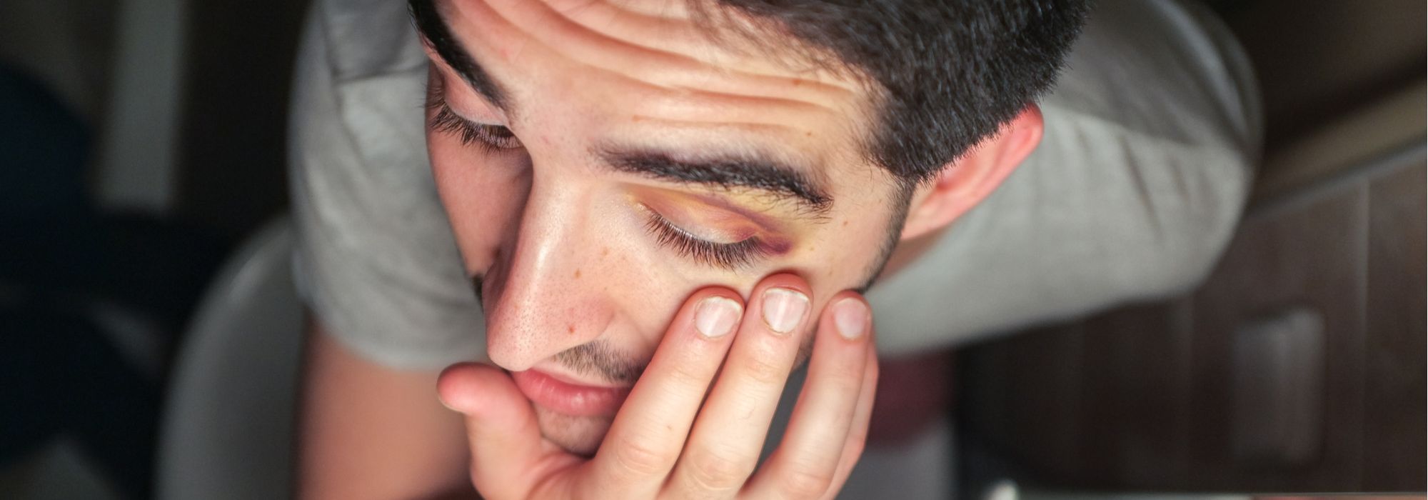 The Black Eye: Head or Face Contusion