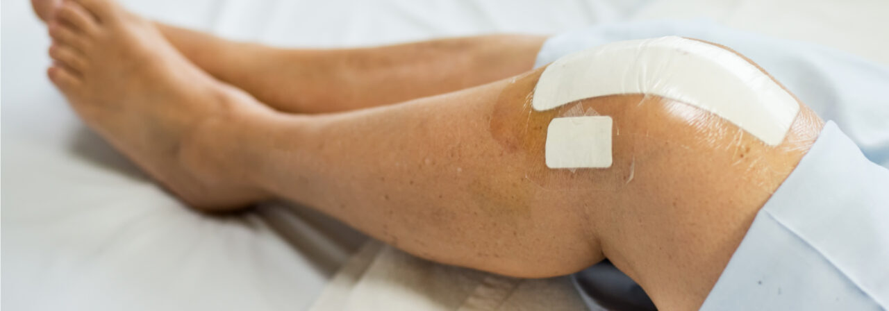 blog_kneereplacementsurgery_feature_12-17.jpg