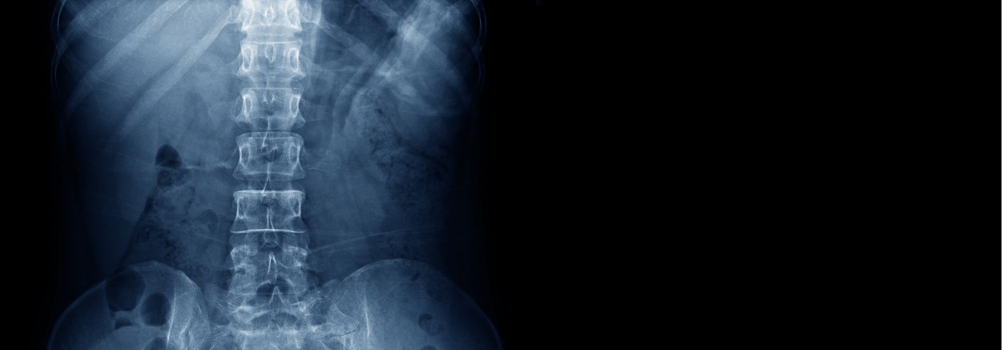 3 Nonsurgical Options For Spinal Stenosis Treatment in Bergen County