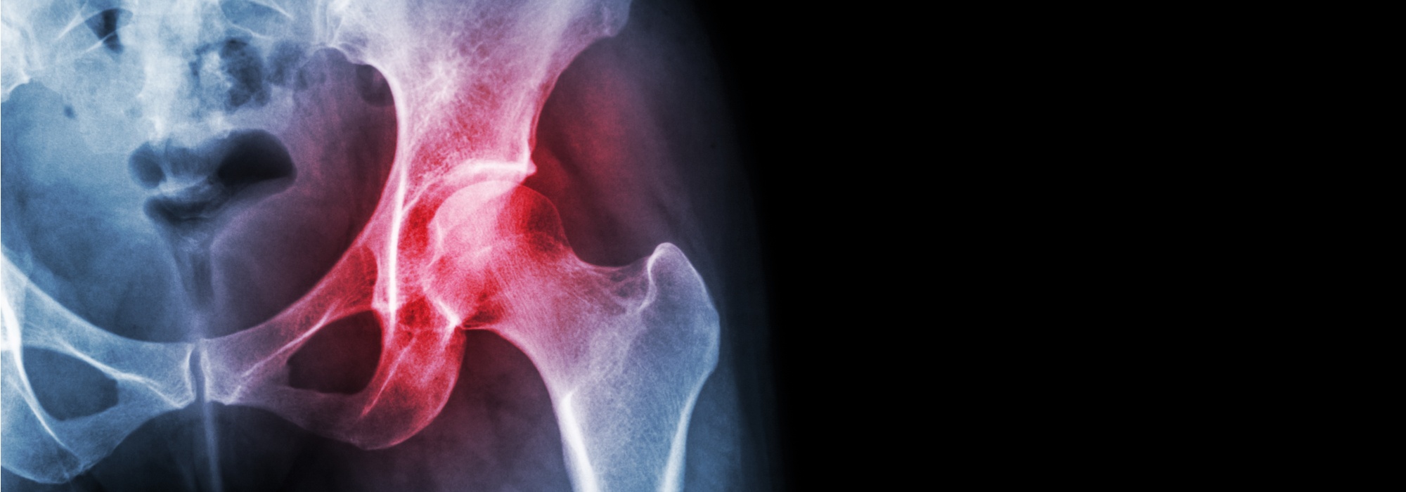Benefits of Hip Preservation Surgery