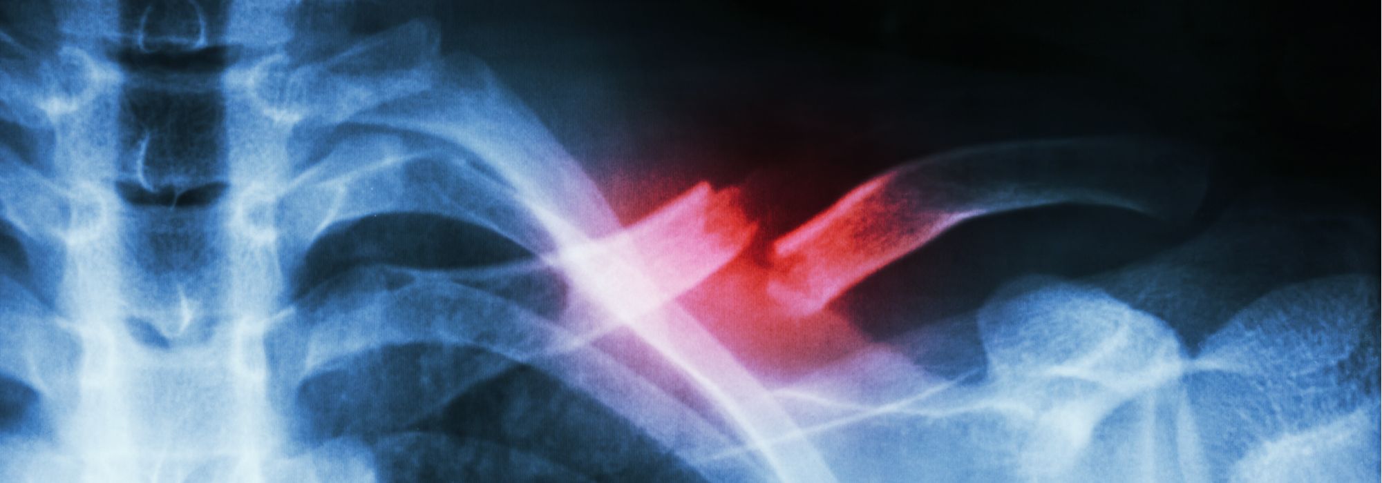 Mountain Bikers: Broken Collarbone Treatment