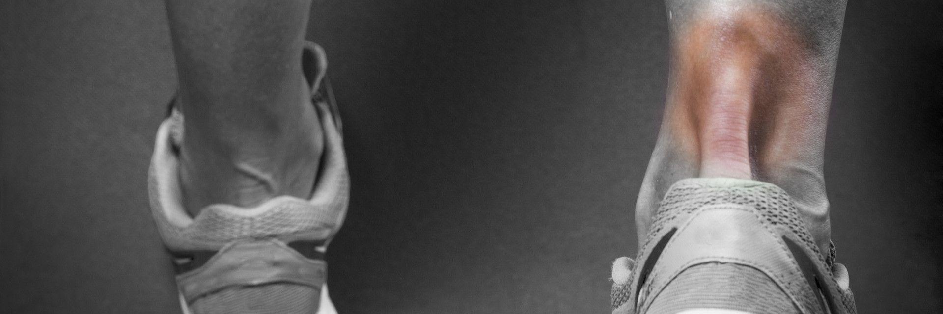 The Rundown on Achilles Tendon Injuries