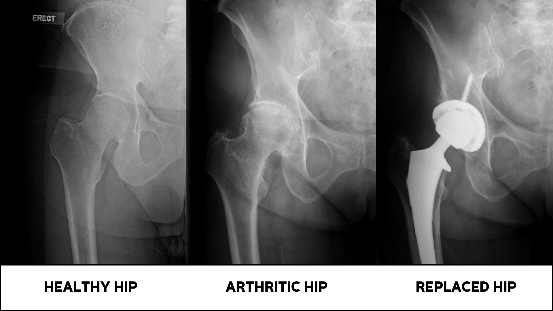 Treatment options for Osteoarthritis of the Hip - Rothman Orthopaedics