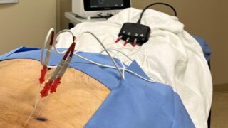 Detailed Exploration of Radiofrequency Ablation - Rothman Orthopaedics