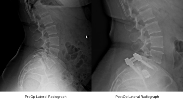 Twining Method Radiography The Role of 3D Imaging and Navigation in Minimally Invasive Spine ...