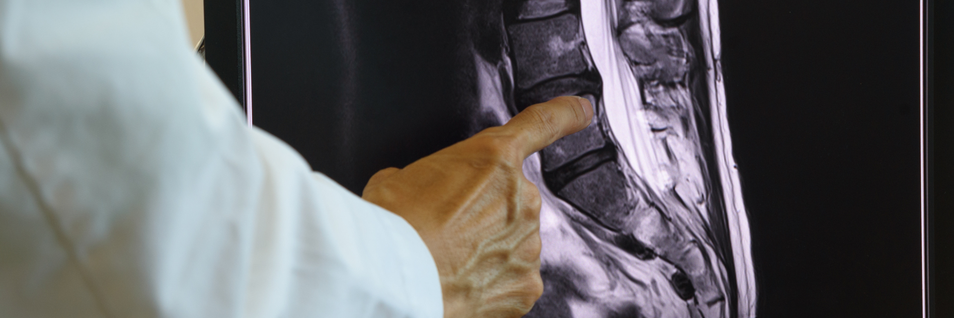 Minimally Invasive Microdiscectomy for Disc Herniation