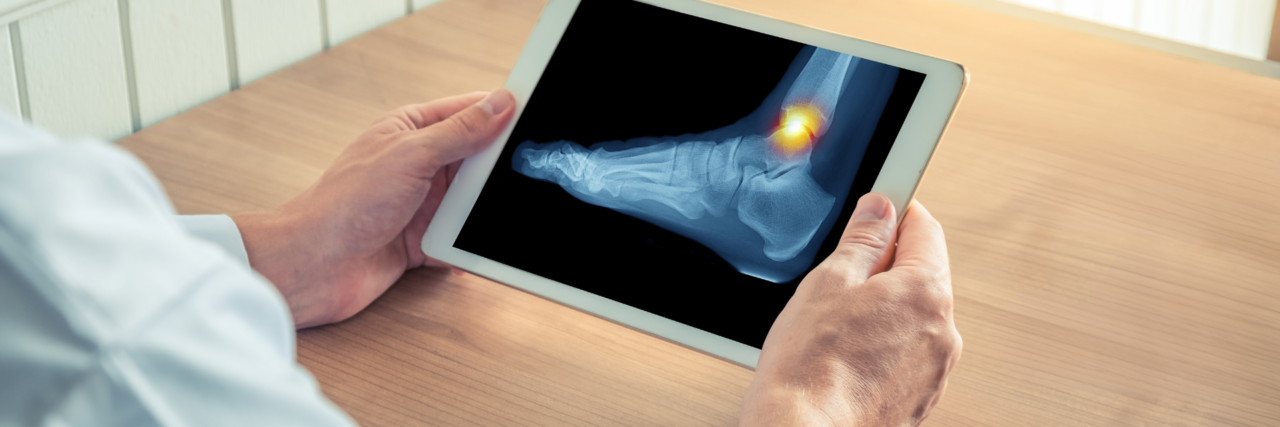totalanklereplacement_anklefusionsurgery_blog.png